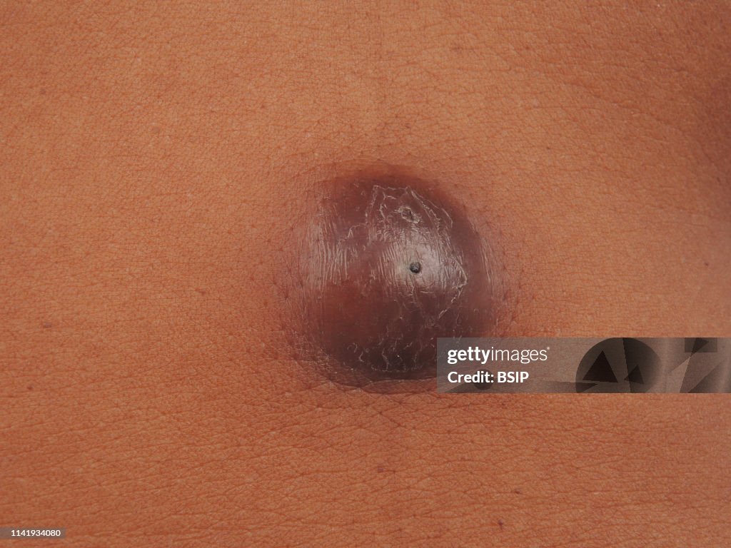 Sebaceous cyst.