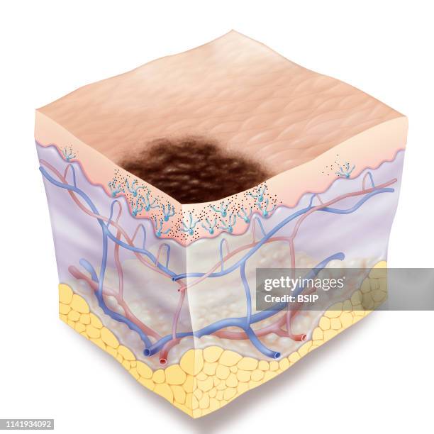 Illustration of a stage 0 melanoma. The melanoma has irregular serrated edges. At stage 0 it is located on the epidermis. This type of skin cancer...
