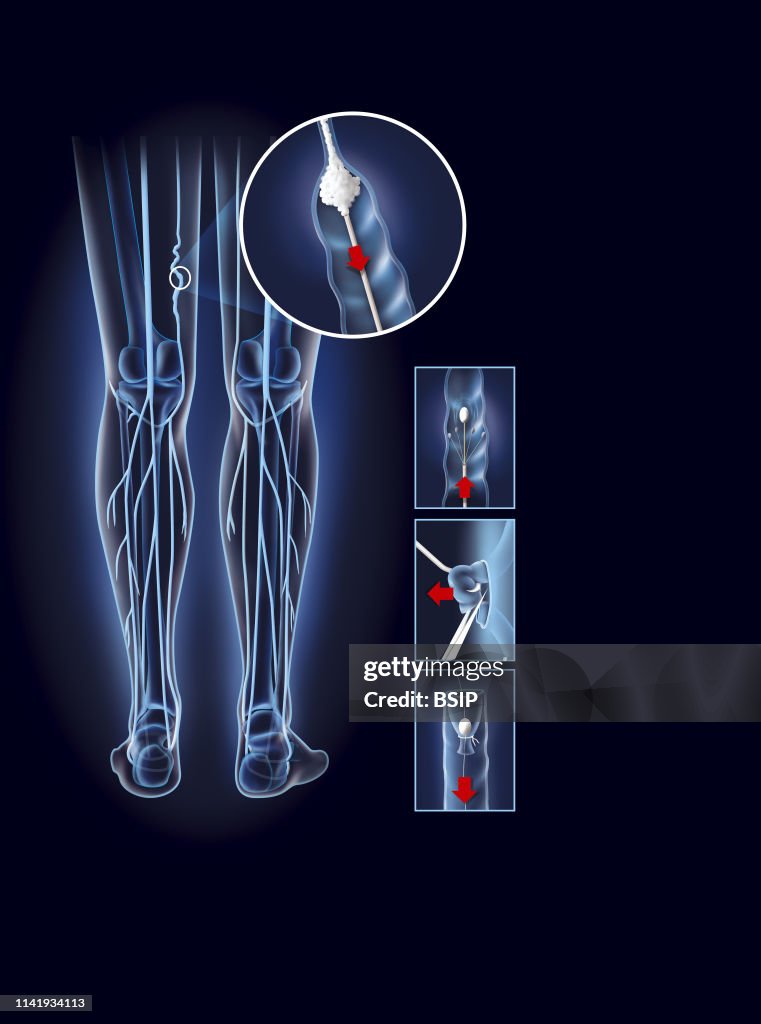 Varicose vein treatment, illustration.