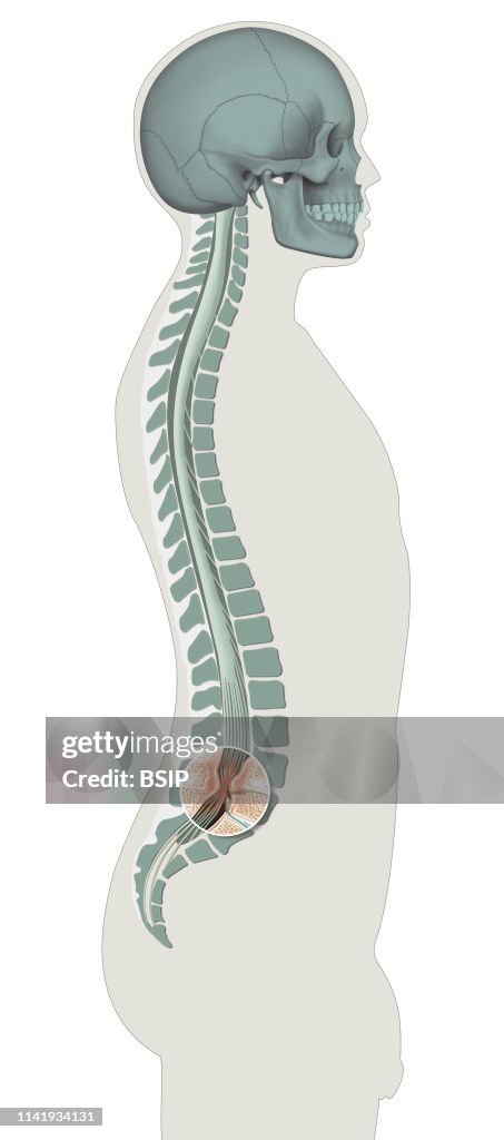 Spinal stenosis.