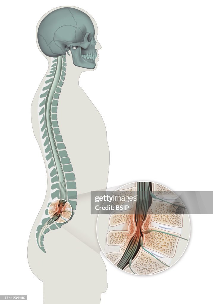 Spinal stenosis.