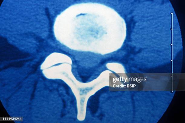 Exploding Disc Back 14 Slipped Back Disc Stock Photos, High-Res Pictures, and Images ...