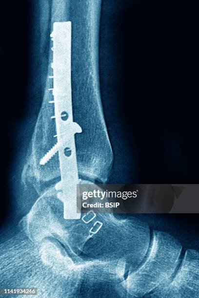 Screw Rph Fractured Ankle Operation Photos and Premium High Res Pictures - Getty ...