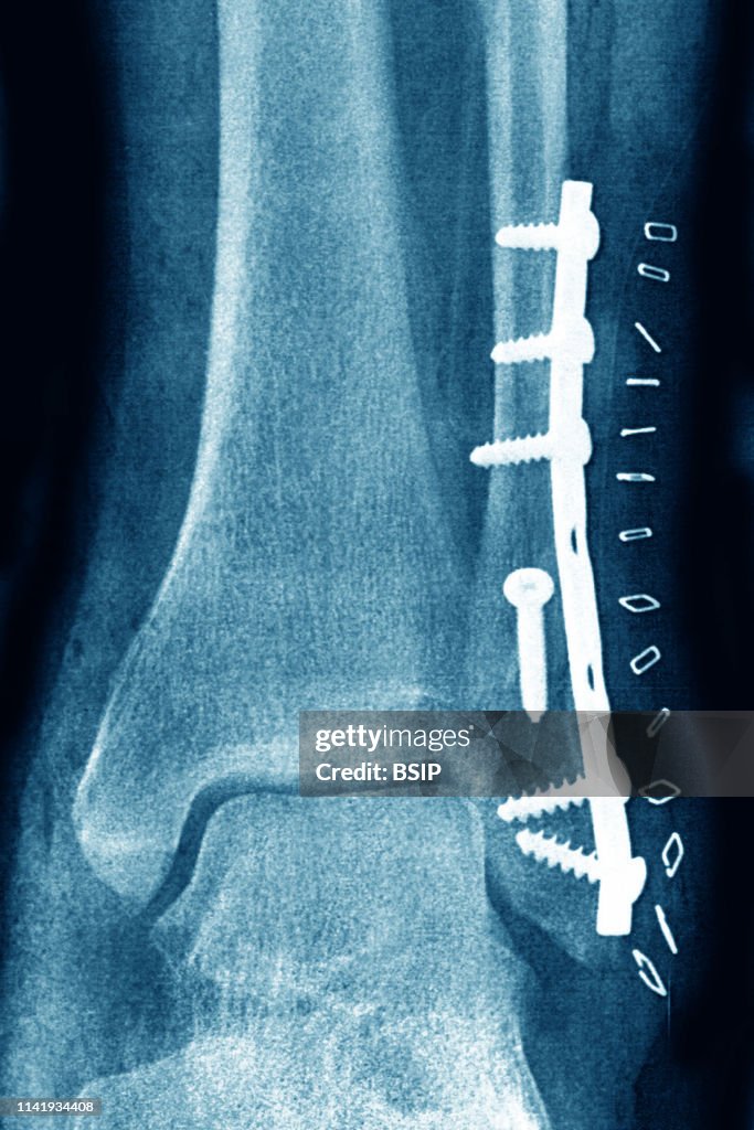 Osteosynthesis on a fracture of the fibula.