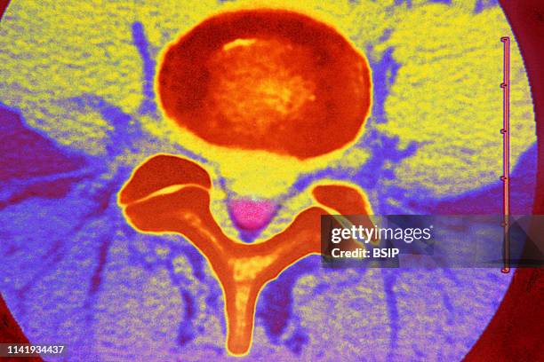 Slipped disc compression of the medulla lumbar vertebra.