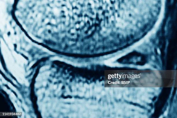 Manusus Meniscus Image Photos and Premium High Res Pictures - Getty Images