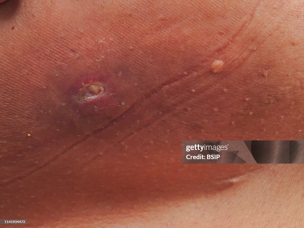 Sebaceous cyst.