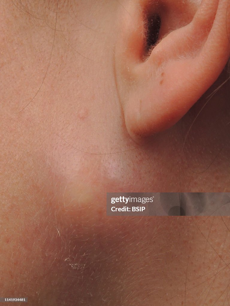 Sebaceous cyst.