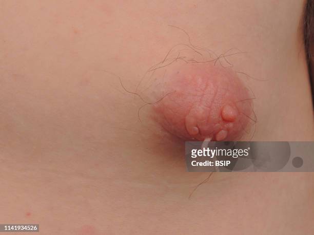 Gynecomastia on a young, 25-year old man.