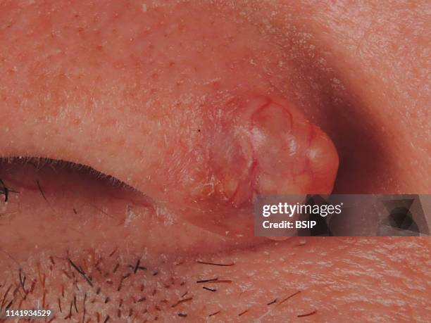 Infiltrating basal cell carcinoma on the nostril.
