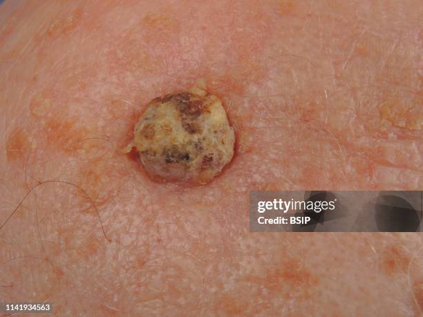 Infiltrating squamous cell carcinoma of the vertex.