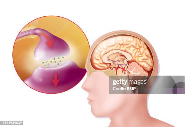 Illustration of Parkinson's disease. It affects dopamine neurons in the substantia nigra. Dopamine, vital for transmitting the nerve impulse used in...