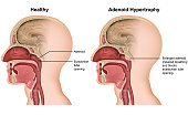 Adenoid hypertrophy medical vector illustration on white background