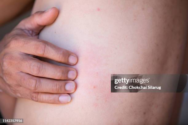 men are scratching the skin caused by hives - herpes zoster stock pictures, royalty-free photos & images