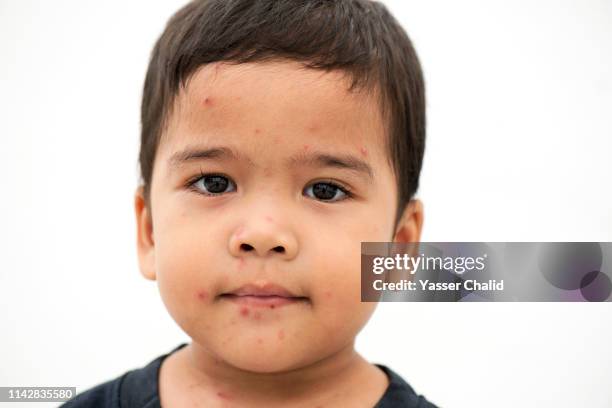 closeup kid with measles - varicela fotografías e imágenes de stock