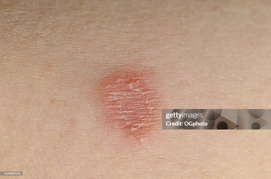 Tinea Corporis Infection High-Res Stock Photo - Getty Images