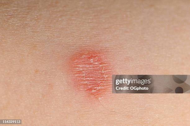 tinea corporis infection (ring worm) - ogphoto stock pictures, royalty-free photos & images