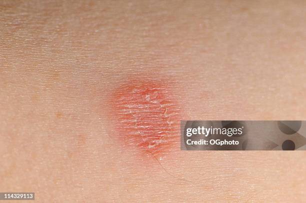 tinha corporis infecção (anel minhoca - tinha imagens e fotografias de stock