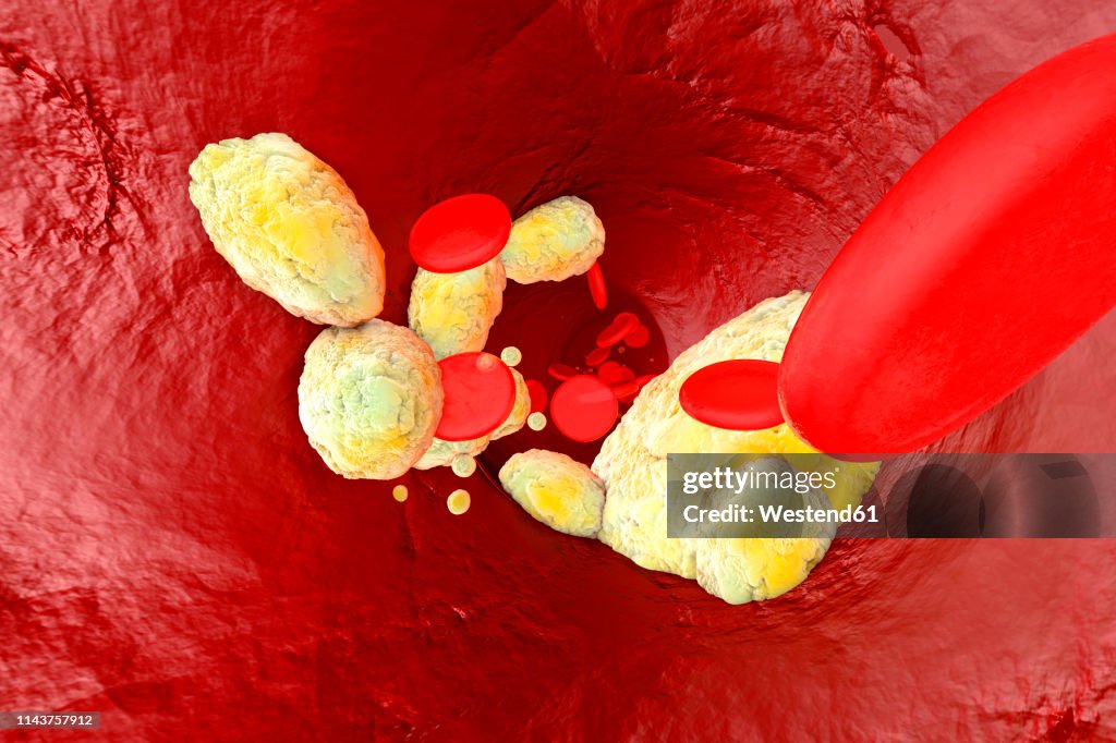 3D Rendered illustration, visualisation of fat clogging a artery and forming the sickness arteriosclerosis