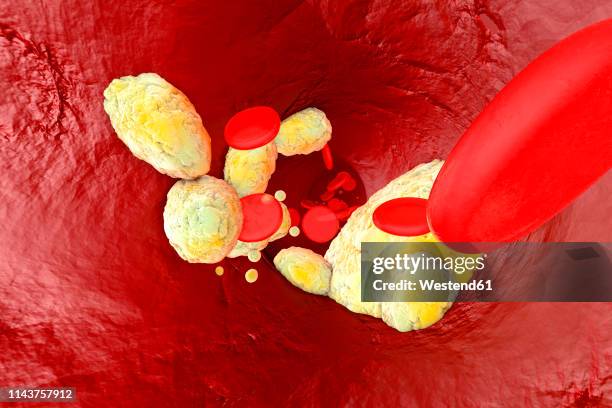 stockillustraties, clipart, cartoons en iconen met 3d rendered illustration, visualisation of fat clogging a artery and forming the sickness arteriosclerosis - atheromatose