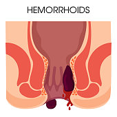 Hemorrhoids and inflammation cause bleeding through the fistula of the patient.