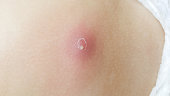 close-up abscess on child skin