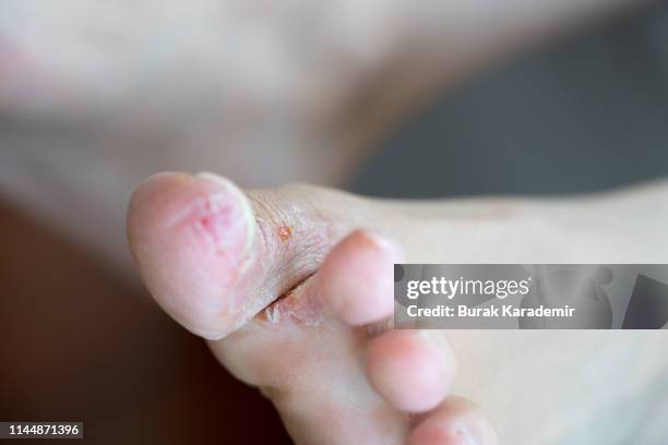 athlete's foot - images of ugly feet stock pictures, royalty-free photos & images