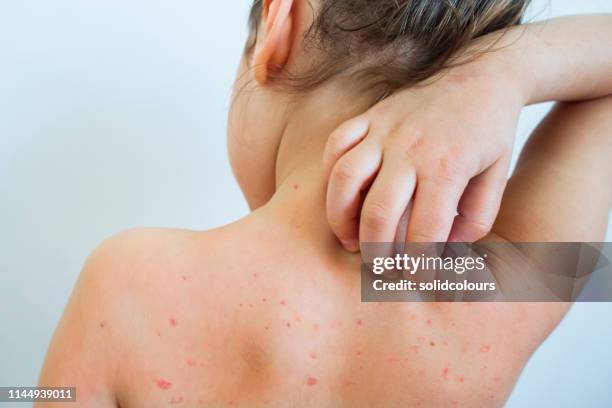 chickenpox - skin condition stock pictures, royalty-free photos & images