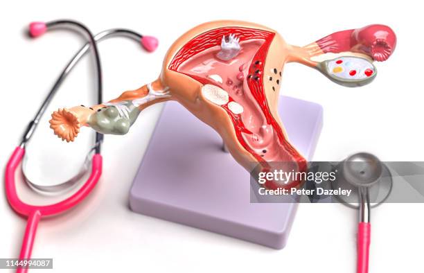 uterus and ovary anatomical model showing common pathologies - endometriosis stock pictures, royalty-free photos & images