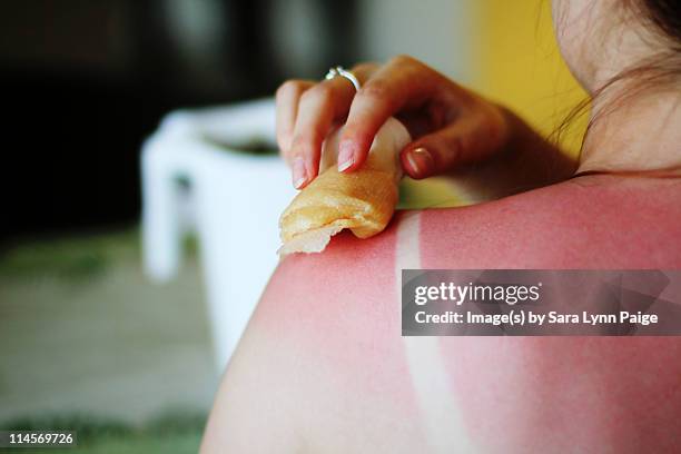 folk remedies for sunburn - sun burn stockfoto's en -beelden