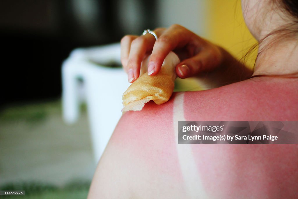 Folk remedies for sunburn