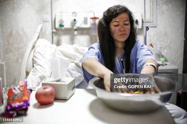 Indian Everest climber Ameesha Chauhan dips her fingers in a warm solution at a hospital in Kathmandu on May 27, 2019. - Ameesha Chauhan, a survivor...