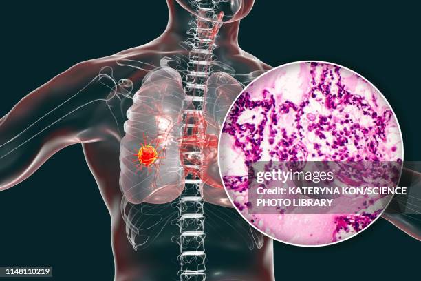 lung cancer, composite image - 光学顕微鏡図点のイラスト素材／クリップアート素材／マンガ素材／アイコン素材