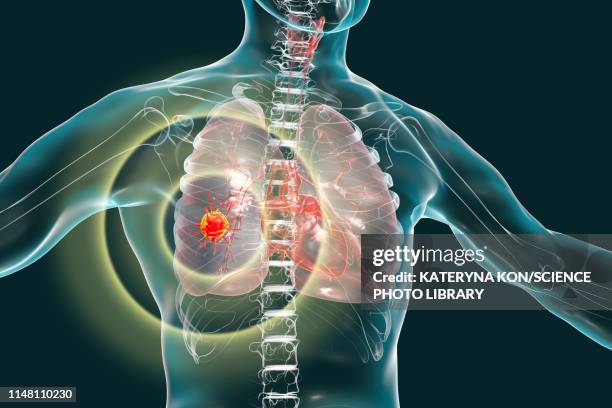 lung cancer, conceptual image - metastatic tumour stock illustrations