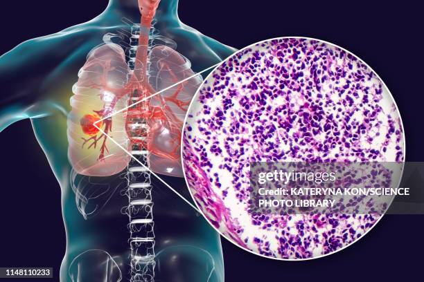 lung cancer, composite image - 光学顕微鏡図点のイラスト素材／クリップ��アート素材／マンガ素材／アイコン素材