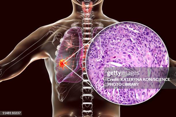 lung cancer, composite image - squamous cell carcinoma stock illustrations
