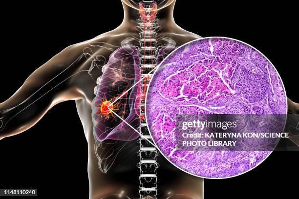 lung cancer, composite image - 光学顕微鏡図点のイラスト素材／クリップアート素材／マンガ素材／アイコン素材