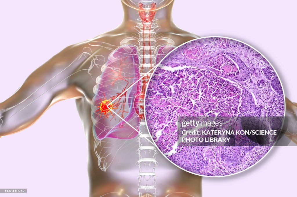 Lung cancer, composite image