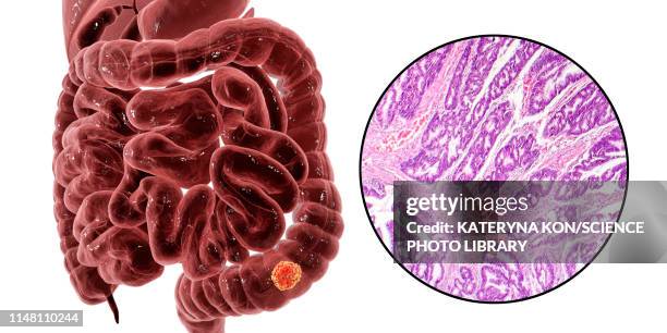 colon cancer, composite image - biopsy stock illustrations