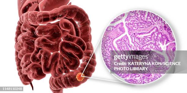 colon cancer, composite image - biopsy stock illustrations