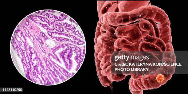 colon cancer, composite image - colorectal cancer screening 幅插畫檔、美工圖案、卡通及圖標