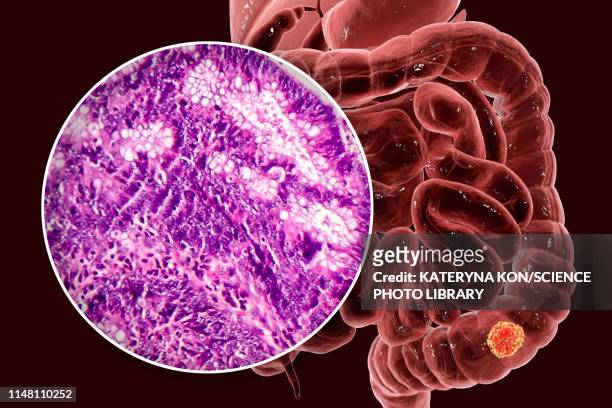 colon cancer, composite image - menschliches gewebe stock-grafiken, -clipart, -cartoons und -symbole