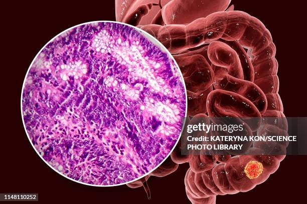 colon cancer, composite image - colon cancer screening stock illustrations
