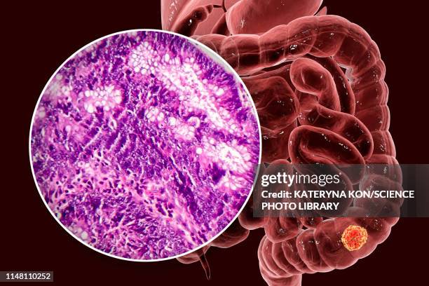 colon cancer, composite image - human tissue stock illustrations