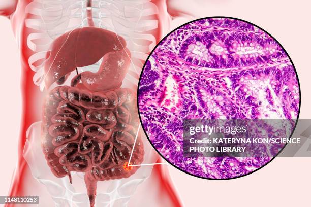 colon cancer, composite image - colorectal cancer screening stock illustrations