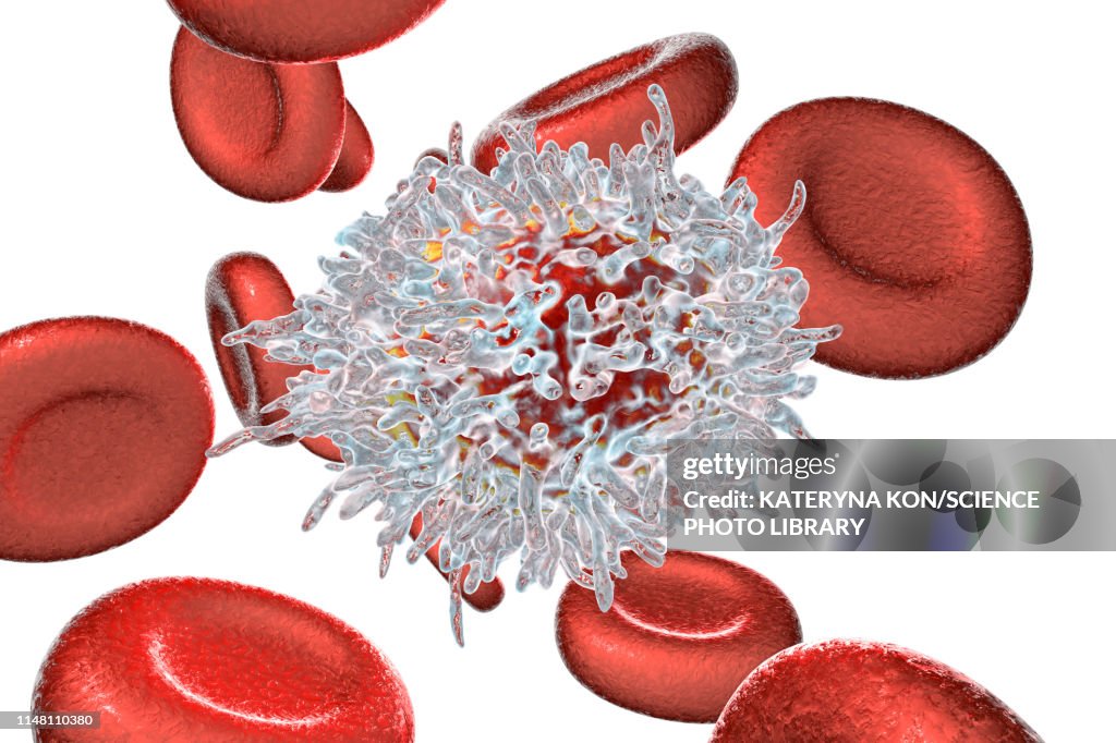 Lymphocyte in hairy cell leukaemia, illustration