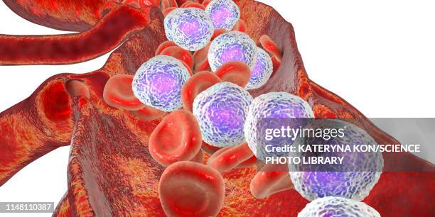 acute lymphoblastic leukaemia, illustration - leukemia点のイラスト素材／クリップアート素材／マンガ素材／アイコン素材