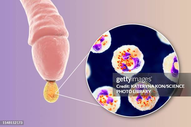 stockillustraties, clipart, cartoons en iconen met gonorrhoea infection in male, illustration - neisseria gonorrhoeae