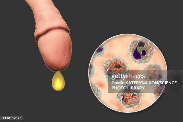 gonorrhoea infection in male, illustration - urethritis stock illustrations