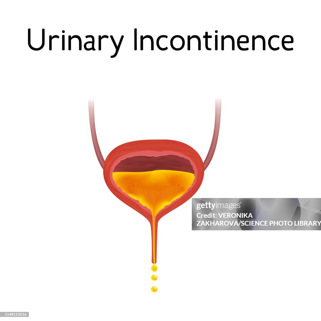 Urinary Incontinence Illustration High-Res Vector Graphic - Getty Images